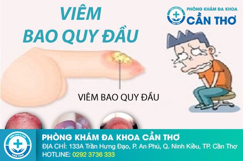 Viêm bao quy đầu